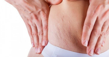 Çatlakları Yok Eden Estetik Yöntemi Fibroderms Nedir?