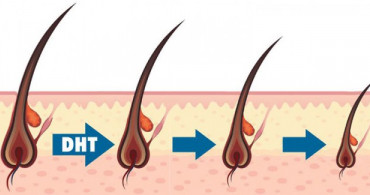 DHT Hormonu Nedir?