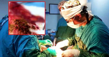 Doktorunu Şaşkına Çeviren Hastanın Midesinden Zeytinlik Çıktı 