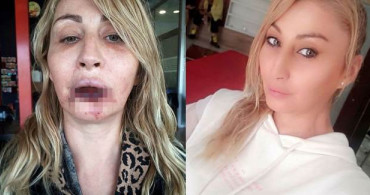 Dolgu Yaptırdı Dudağını Kaybetti! Yaşadığı Dehşet Anlarını Böyle Anlattı