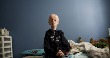 Erken Yaşlanma Hastalığı Progeria Nedir, Belirtileri Neler?