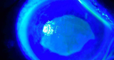 Kırlangıç Otu Kullanımında Dikkat Edilmesi Gerekenler