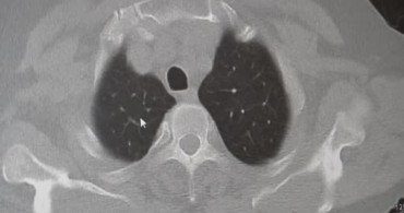 KOAH ve Zatürre Hakkında Kritik Uyarılar