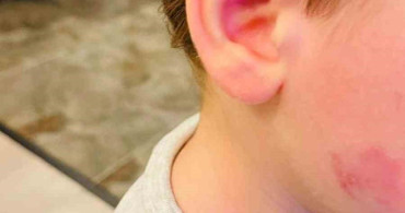 Kreşte Darp Olayı: Çocuk Sağlıklı Kaldı, Akşam Darp Edilmiş Bulundu