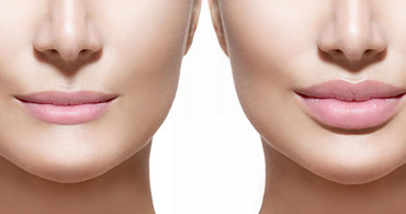 Liplift (Dudak Kaldırma) Nedir? Nasıl Uygulanır?