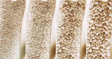 Osteoporoz Belirtileri Nelerdir?