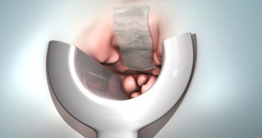 Pandemi Döneminde Hemoroidal Hastalıklar Arttı