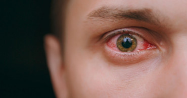 Retina Yırtılması Nedir, Retina Yırtılması Nasıl Tedavi Edilir?