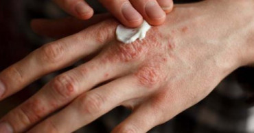 Sedef Hastalığı Psoriasis Nedir? Belirtileri ve Tedavileri Nelerdir?