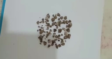Siirt'te Modern Cerrahi ile Böbrek Taşı Temizliği