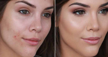 Sivilceli Ciltlerin Yaptığı Makyaj Hataları