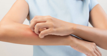 Uyuz hastalığı nedir, belirtileri neler? Uyuz hastalığında döküntü ve kaşıntıları geçirmek için öneriler