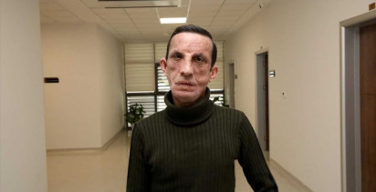 Türkiye'nin İlk Yüz Nakli Kutlandı