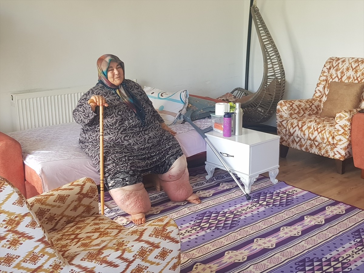 
Osmaniye'de yaşayan ve fil hastalığı (Lenfödem) nedeniyle aşırı kilo alan ve dışarı çıkamayan...
