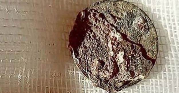 6 Yaşında Burnuna Kaçan Bozuk Para 59 Yaşında Çıkarıldı
