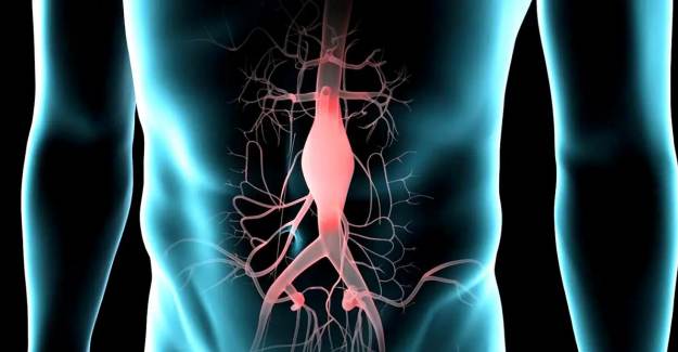 Abdominal Aort Anevrizması Nedir