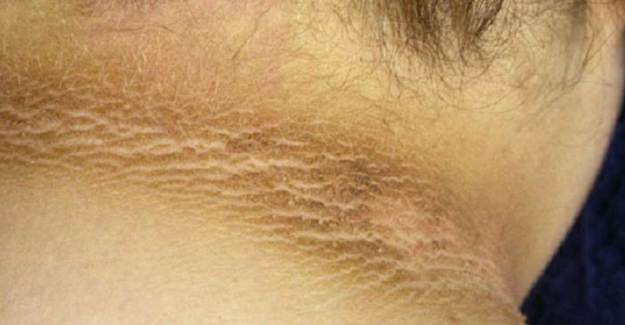 Akantozis Nigrikans (Acanthosis Nigricans) Nedir?