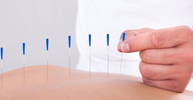 Akapunktur Nedir? Akapunktur Nasıl Etki Eder? Akapunktur Tedavisi Nasıl Yapılır ve Hangi Hastalıkların Tedavisinde Kullanılır?