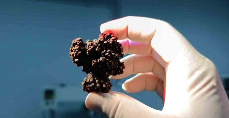 Bozyazı'da 4 santimetrelik mesane taşı tek parça halinde çıkarıldı