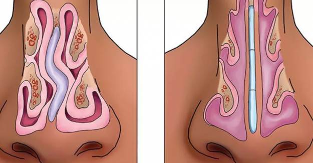 Burun Eti (Septum Deviasyonu) Nedir?