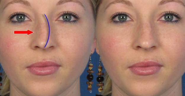 Burun Kemik Eğriliği (Septum Deviasyonu) Nedir?