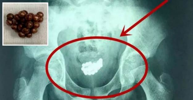 Cinsel Organından 29 Bilye Çıkarıldı