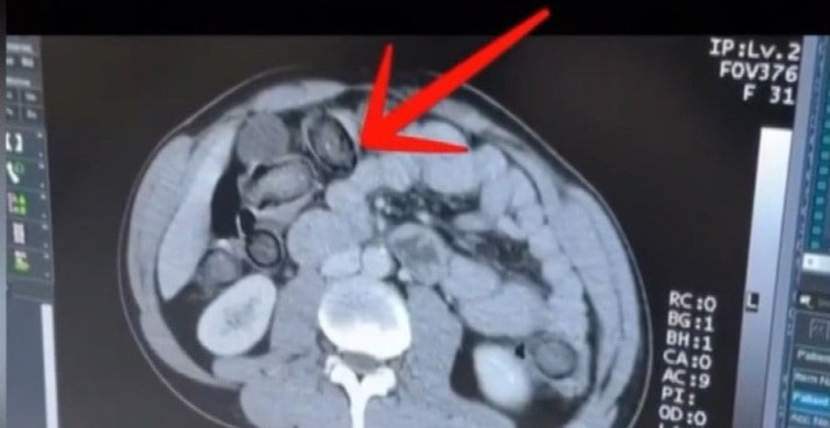 Erzincan'da uyuşturucu operasyonu: 983 gram metamfetamin yakalandı