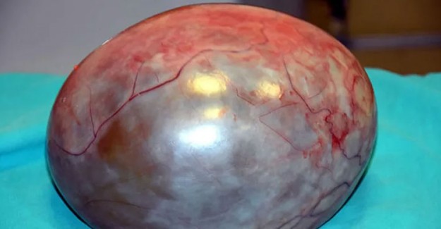  Hakkari'de Bir Kadının Karnından 3 Kilo 400 Gram Kitle Çıktı