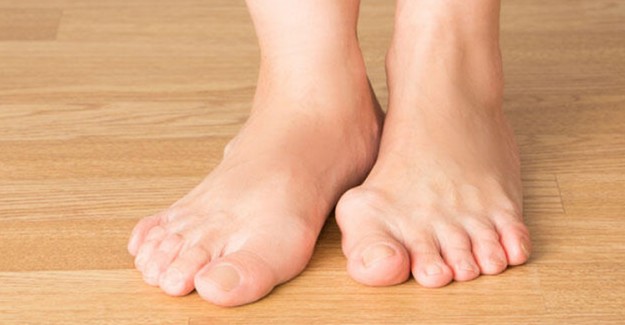 Halluks Valgus Nedir? Nasıl Tedavi Edilir?