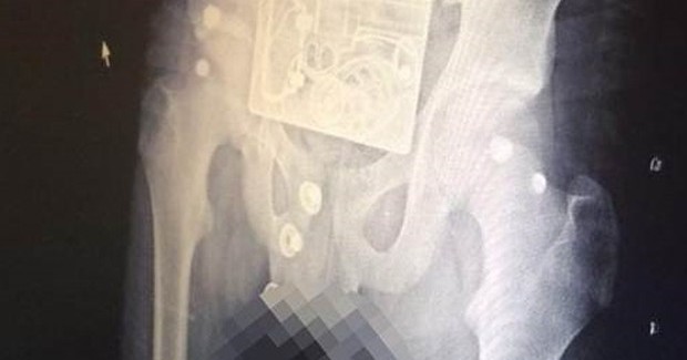Hastanede Büyük Panik! Röntgende Görünenler Kan Dondurdu