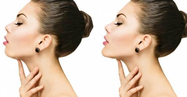 Jawline Çene Dolgusu Nedir?