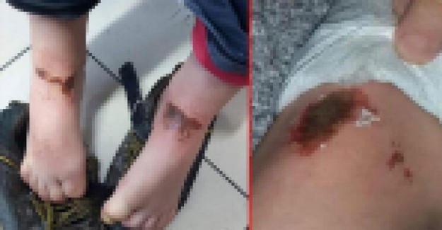 Kar Topu Oynarken Yanmışlardı! Sebebi Alkaliymiş