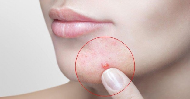 Kistik Akne Nedir? Kistik Akne Neden Oluşur?