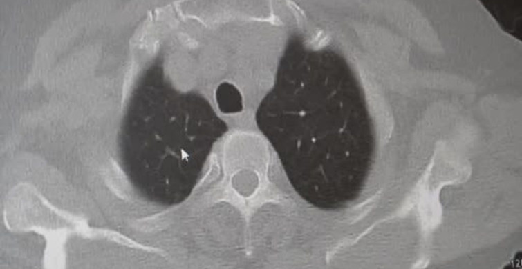 KOAH ve Zatürre Hakkında Kritik Uyarılar