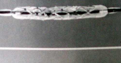 Koroner Kalp Hastalığı İçin Saç Teli Kalınlığında Stent Geliştirildi