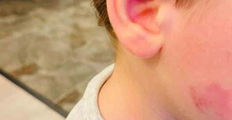 Kreşte Darp Olayı: Çocuk Sağlıklı Kaldı, Akşam Darp Edilmiş Bulundu