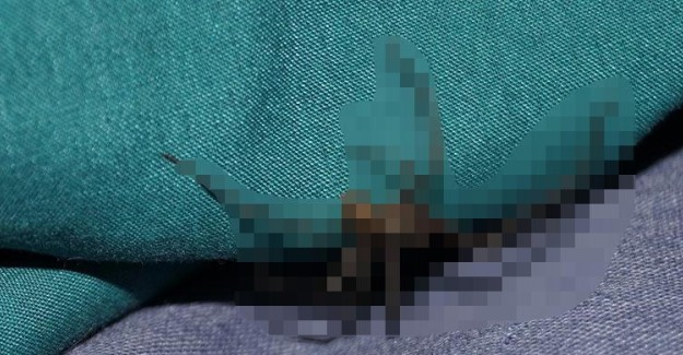Kulak Ağrısı Şikayetiyle Doktora Başvuran Kadının Kulağından Örümcek Çıktı