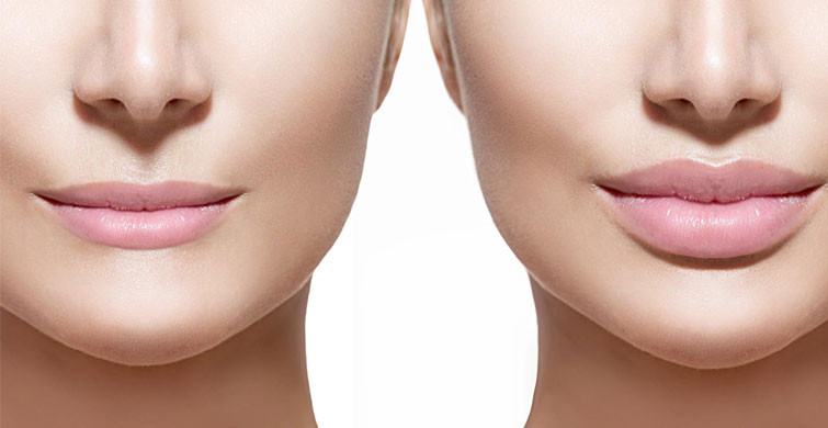 Liplift (Dudak Kaldırma) Nedir? Nasıl Uygulanır?