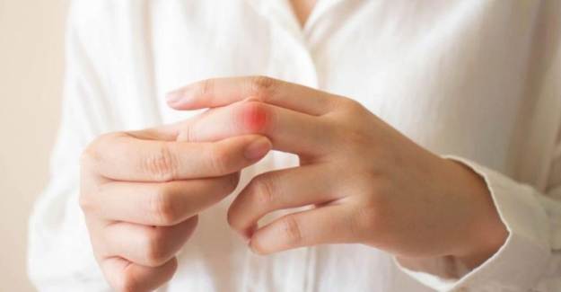 Lupus Hastalığının Bitkisel Tedavi Yöntemleri