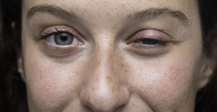 Myasthenia Gravis Nedir?