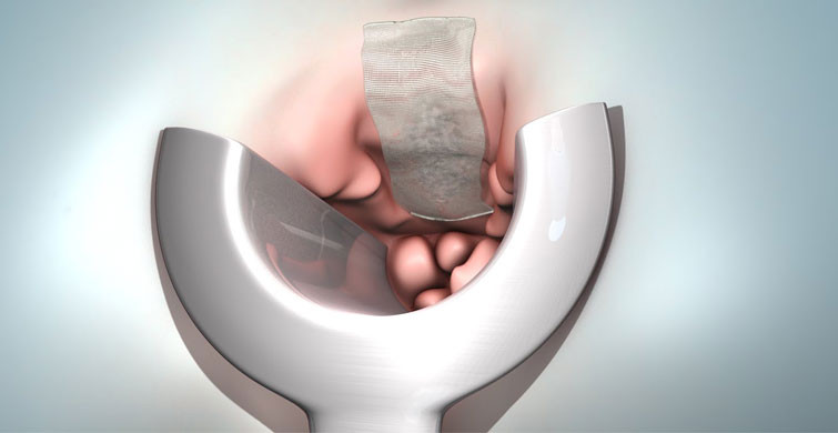 Pandemi Döneminde Hemoroidal Hastalıklar Arttı