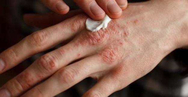 Sedef Hastalığı Psoriasis Nedir? Belirtileri ve Tedavileri Nelerdir?