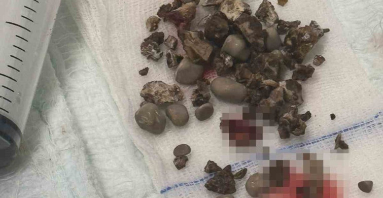 Siirtte Böbrek Taşı Tedavisinde Yeni Başarı