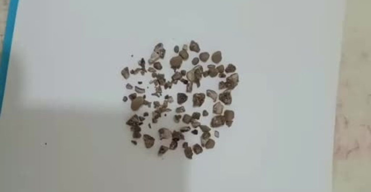 Siirt'te Modern Cerrahi ile Böbrek Taşı Temizliği