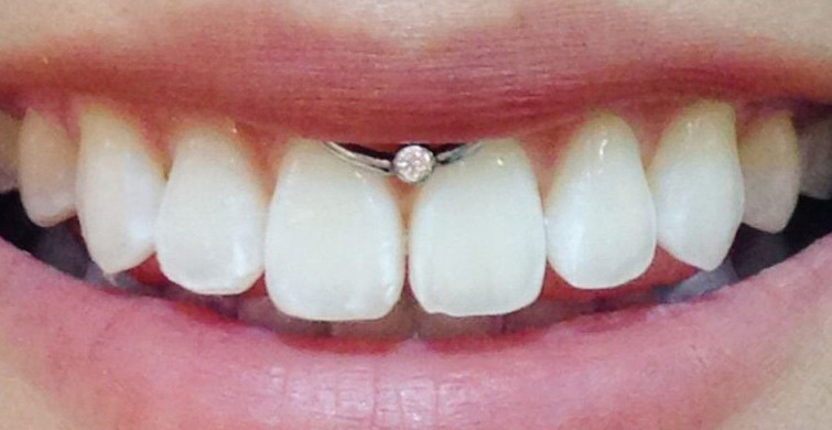 Smiley Piercing Zararları Nelerdir?