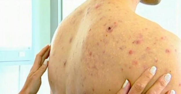 Vücuttaki Sivilceler İçin Maske Önerisi