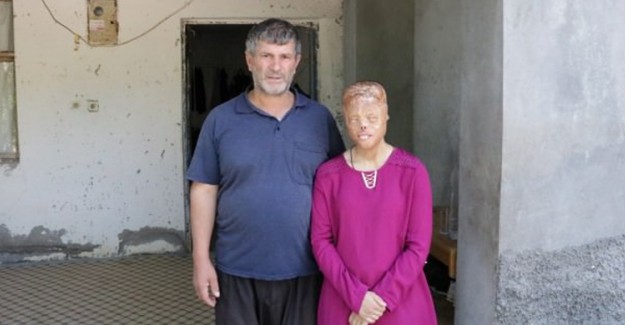 Yüz Nakli Olmak İçin Bekleyen Leyla Demirci İçin Sağlık Bakanlığı Harekete Geçti