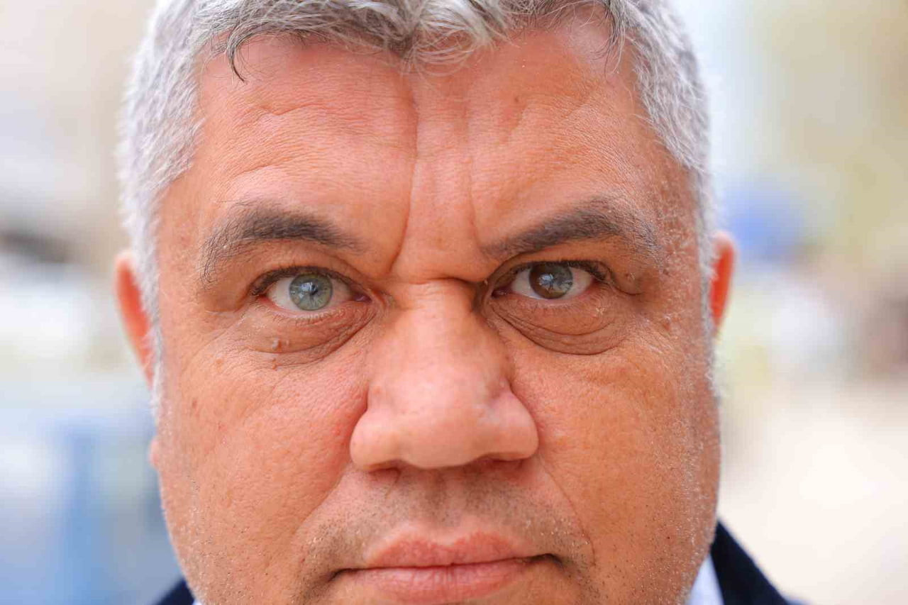 KAHRAMANMARAŞ’TA DOĞUŞTAN RENKLİ GÖZLÜ OLAN MEHMET ESER’İN SOL GÖZÜ KAHVERENGİ VE YEŞİL, SAĞ GÖZÜ...