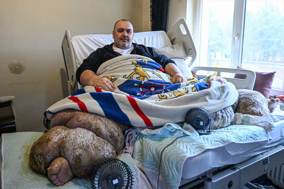 Kayseri'nin Sarıoğlan ilçesinde 12 yıl önce yakalandığı fil hastalığı nedeniyle yaklaşık 300...