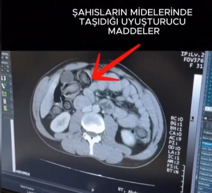 MİDEYE GİZLENEN UYUŞTURUCU ERZİNCAN'DA ELE GEÇİRİLDİ